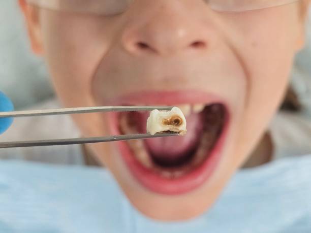 Best Emergency Tooth Extraction in Fair Lakes, VA
